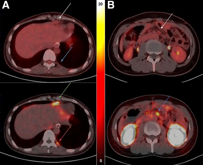 Imagen: Las imágenes PET de cuerpo entero con 68Ga-NC-BCH se dirigen rápidamente a un importante biomarcador de cáncer gastrointestinal (foto cortesía de Qi, Guo, et al.; Doi.org/10.2967/jnumed.123.267110)